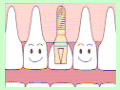 �C���v�����g